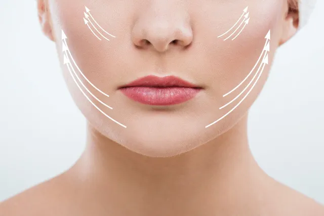 endolift Double menton