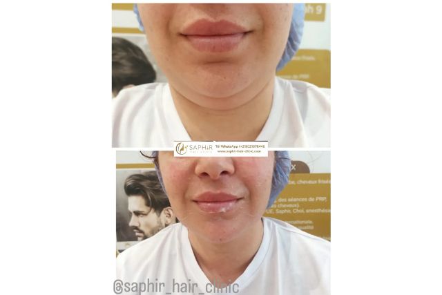 Résultats Endolift _ avant _ après