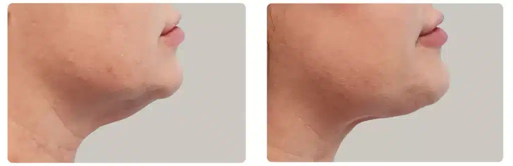 double mento esthetique