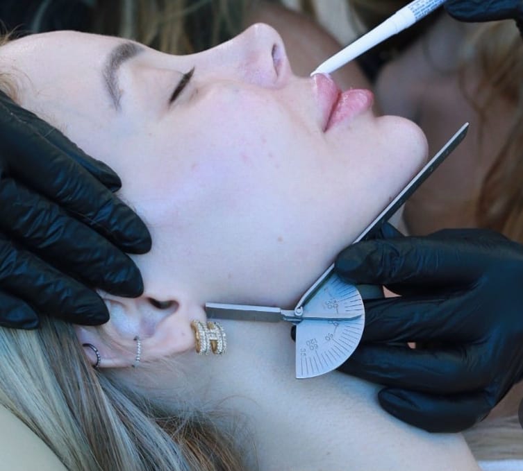 Endolift, lifting sans chirurgie