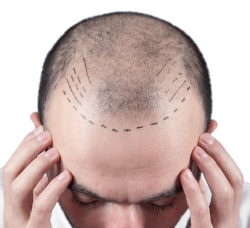 Greffe de cheveux ratée