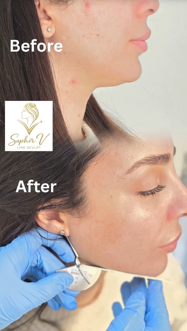 Endolift double menton