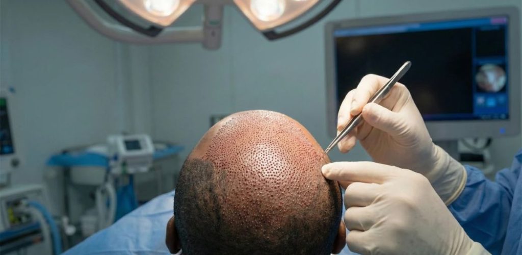 PRP Exosomes Mesotherapie et Dutasteride Le Protocole Exclusif Saphir Hair Clinic