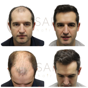 Greffe de cheveux en Tunisie