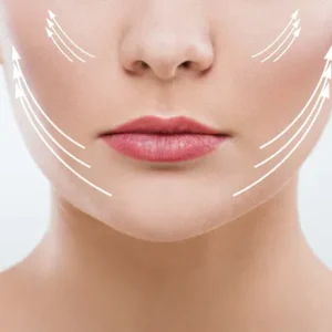 endolift Double menton