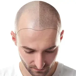 Greffe de cheveux en Tunisie